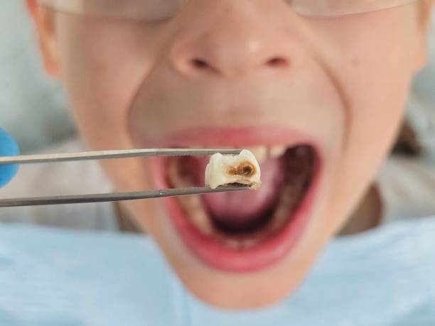 Best Emergency Root Canal Treatment in Jamestown, NY